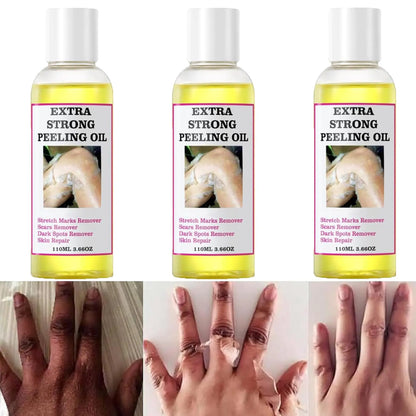 Generic Peeling Oil Extra Strong Peeling Oil Yellow Peeling Oil for Dark Skin Exfoliating Peeling Solution for Body Hand Feet and Face All Skin Type (330ML/11.7 Fl Oz)